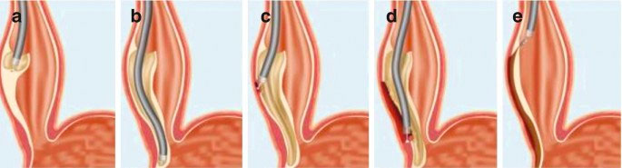 POEM per oral endoscopic myotomy