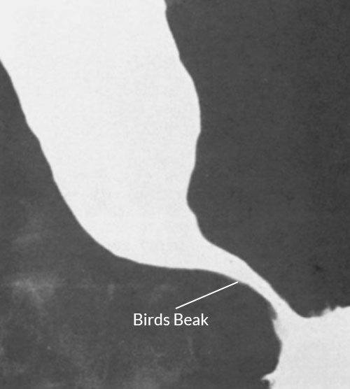 Barium swallow test birds beak