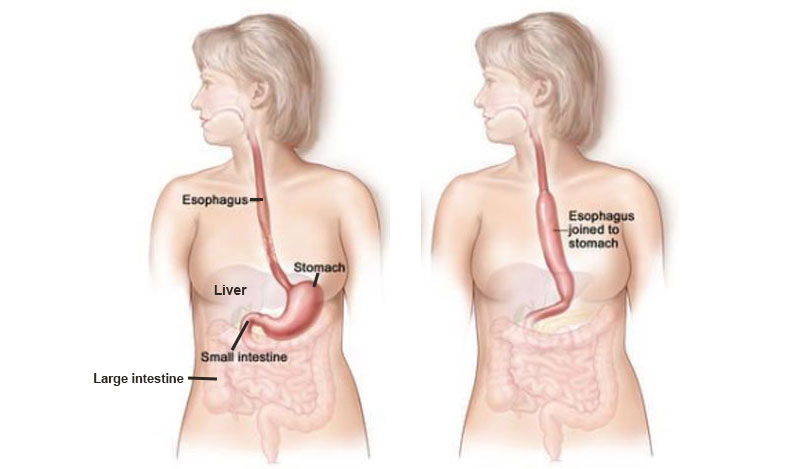 diagram of oesophagectomy