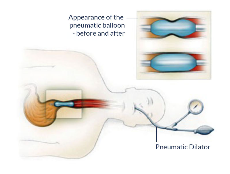Dilatation involves passing an endoscope through your throat with a balloon device attached to the equipment.